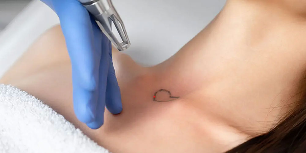 Eliminación de Tatuajes